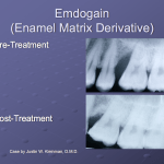 Emdogain before and after