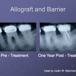 Before and After of Allograft and Barrier with Emdogain