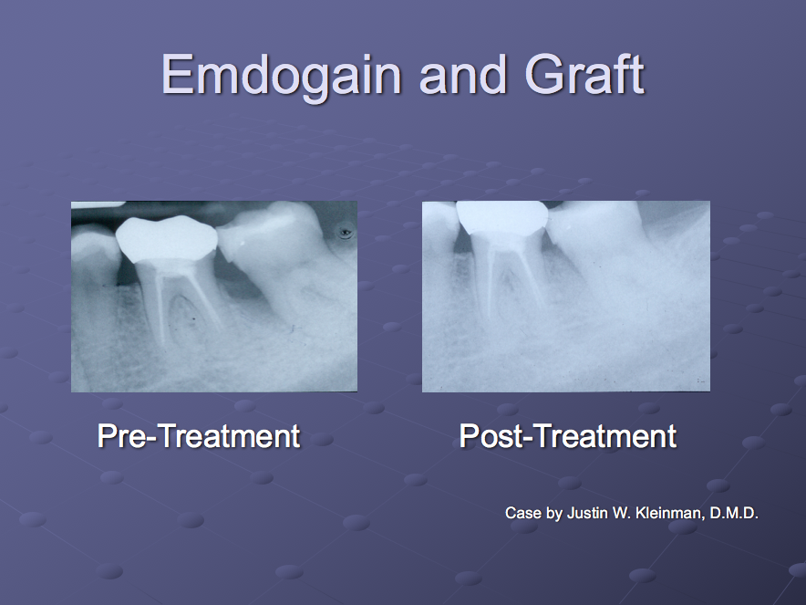 Before and after treatment with Emdogain and Bone Grafting