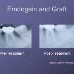 Before and after treatment with Emdogain and Bone Grafting