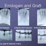 Before and After of Emdogain and Bone Graft
