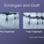 Patient Case Study with Emdogain and Bone Graft