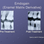 Before and After of Emdogain