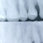 Before and After Bone and Tissue Regeneration
