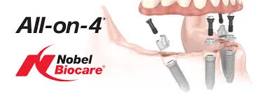 All-on-4® Nobel Biocare