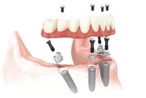 All-on-4® illustration