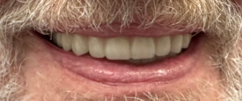 after implant