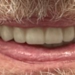 after implant