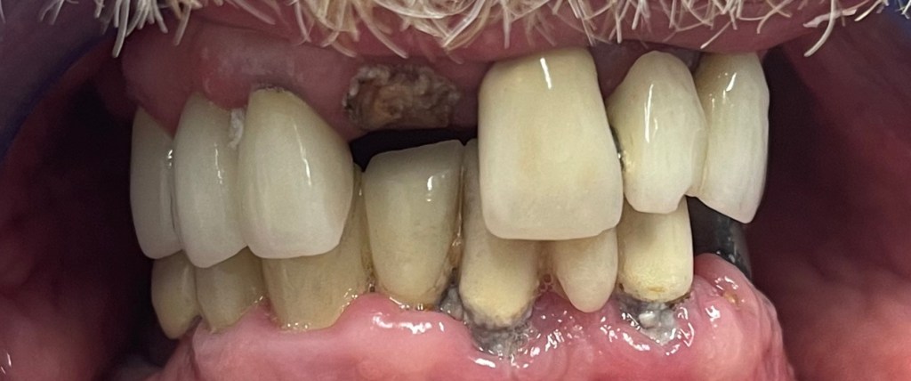 before implant