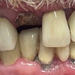 before implant
