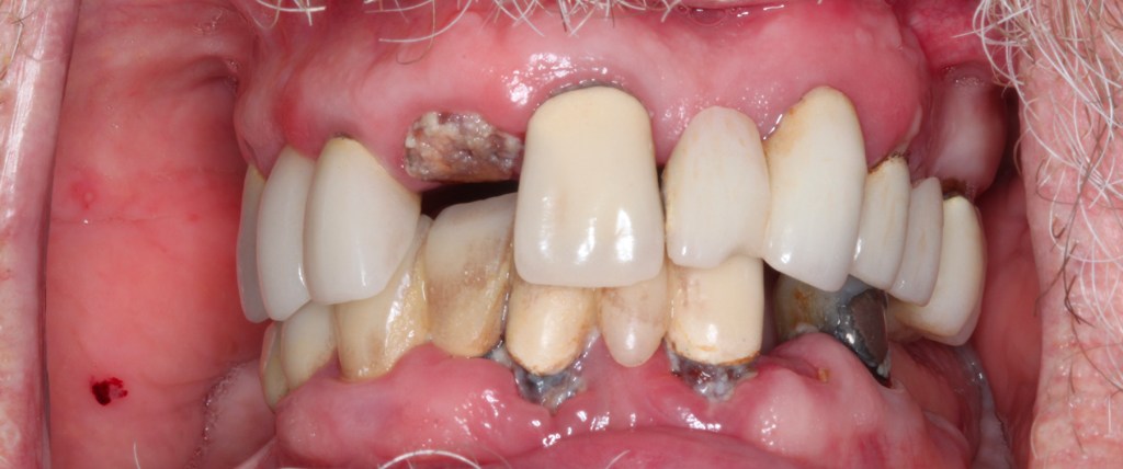 before implant