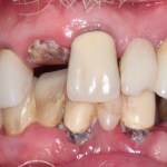 before implant