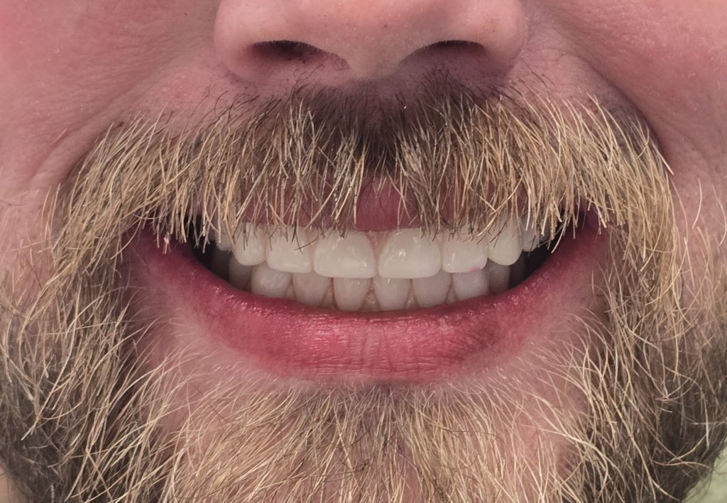 After All on 4 Implants