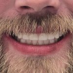 After All on 4 Implants