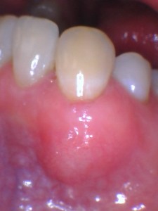 After Gum Graft