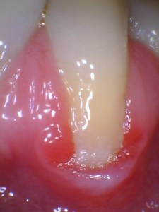 Before Gum Graft