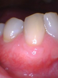 After Gum Graft