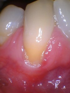 Before Gum Graft