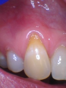 Before Gum Graft
