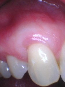 After soft tissue grafting