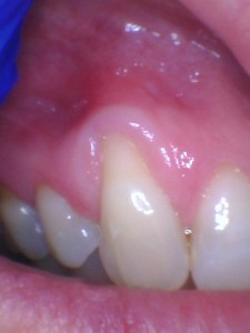 Before soft tissue grafting