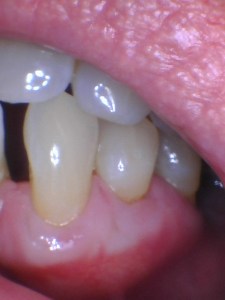 Soft tissue grafting after