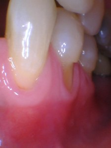 Soft tissue grafting before