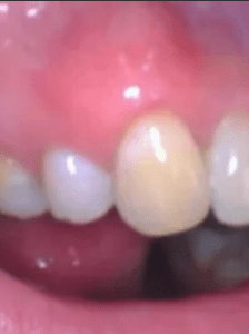 After Gum Graft